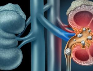 Bu besinler böbrek taşı oluşumunu destekliyor!