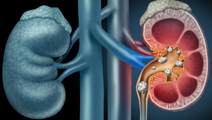 Bu besinler böbrek taşı oluşumunu destekliyor!