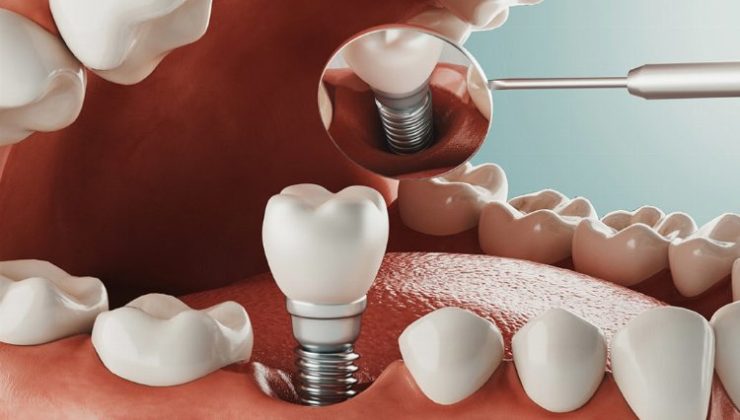 Diş tedavisinde implant zorlu bir süreç mi?